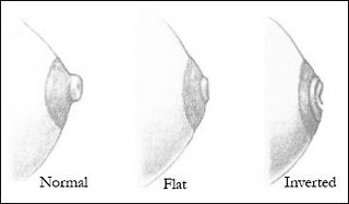 breast causes nipples inverted of